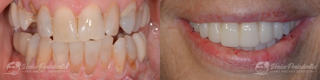 wat 0007 dental implants patient1a