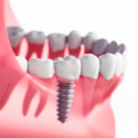 dental implants diagram
