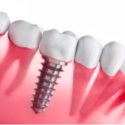 another dental implants diagram