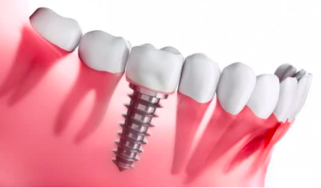 facts about implants