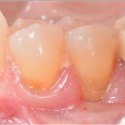 gum disease closeup