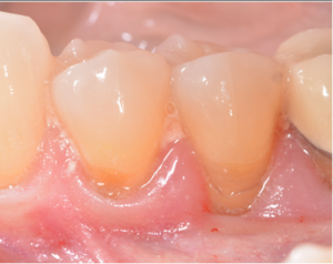 gum disease before 300x238